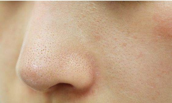 4 Cách đơn giản giúp cải thiện lỗ chân lông to cải thiện lỗ chân lông to