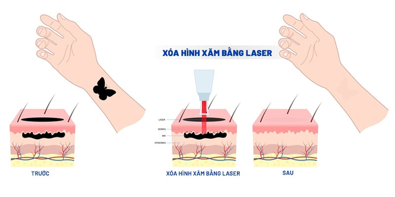 lưu ý khi xóa hình xăm