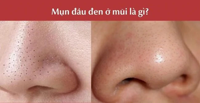 5 Cách Lột Mụn Đầu Đen Tại Nhà Hiệu Qủa Thế nào là mụn đầu đen?