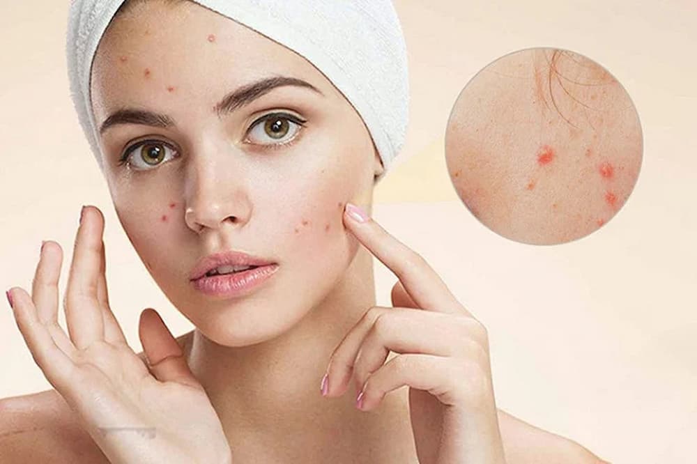 3 lưu ý khi chăm sóc da bị mụn và sau khi hết mụn Những lưu ý khi chăm sóc da bị mụn và sau khi hết mụn