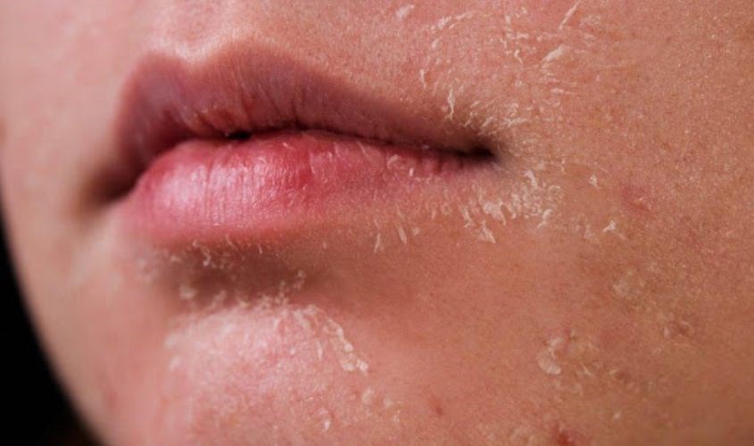 Da mặt khô, nguyên nhân là gì? Da mặt khô, nguyên nhân là gì?